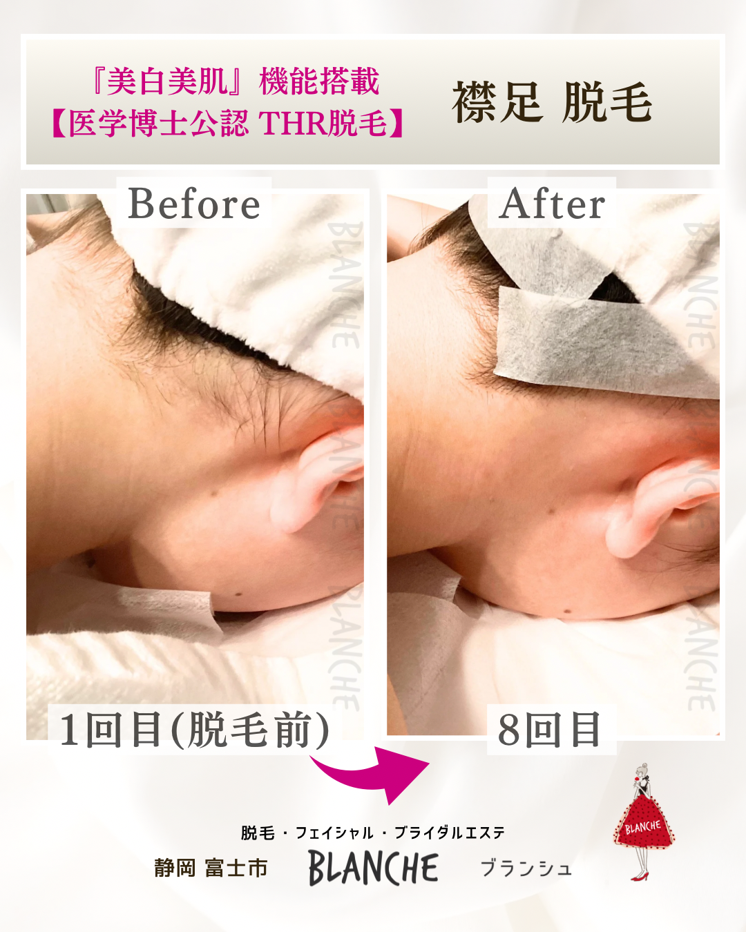 祝成人！襟足のビフォーアフター【富士市ブランシュ】